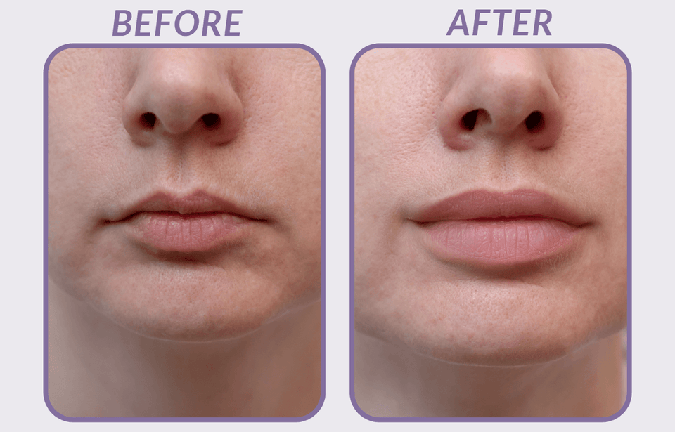 lips filler before and after